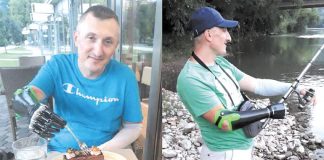 Zeničanin Rasim Redžić živi sa „robotskom rukom“