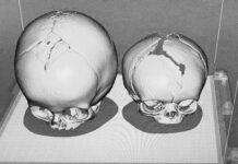 Nastavak uspješnog projekta 3D rekonstruktivnih zahvata na lobanji