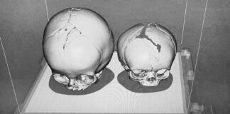 Nastavak uspješnog projekta 3D rekonstruktivnih zahvata na lobanji